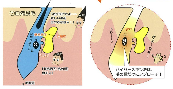 ハイパースキン脱毛の仕組み