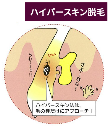 ハイパースキン脱毛の仕組み