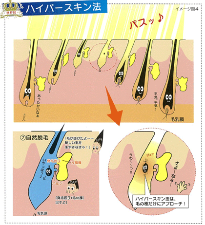 ハイパースキン脱毛の仕組み