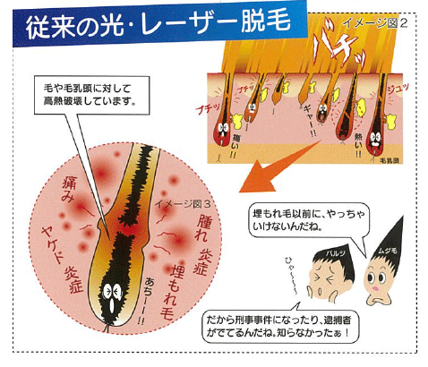 光脱毛の仕組み