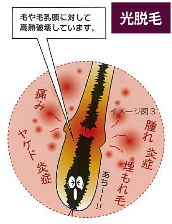 光脱毛の仕組み