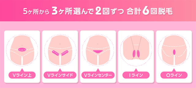 VIOライン6回脱毛に含まれる部位
