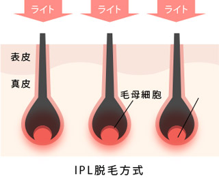 IPL脱毛