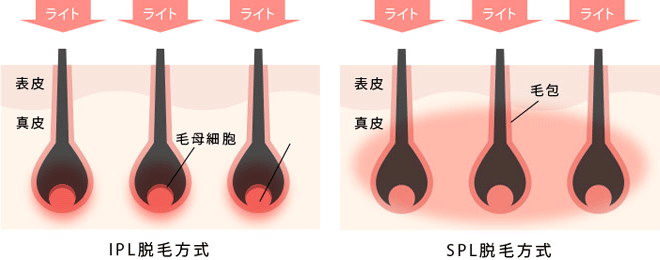 IPL脱毛とSPL脱毛の比較