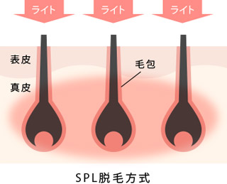 SPL脱毛