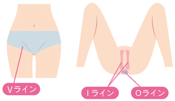 VIOの範囲