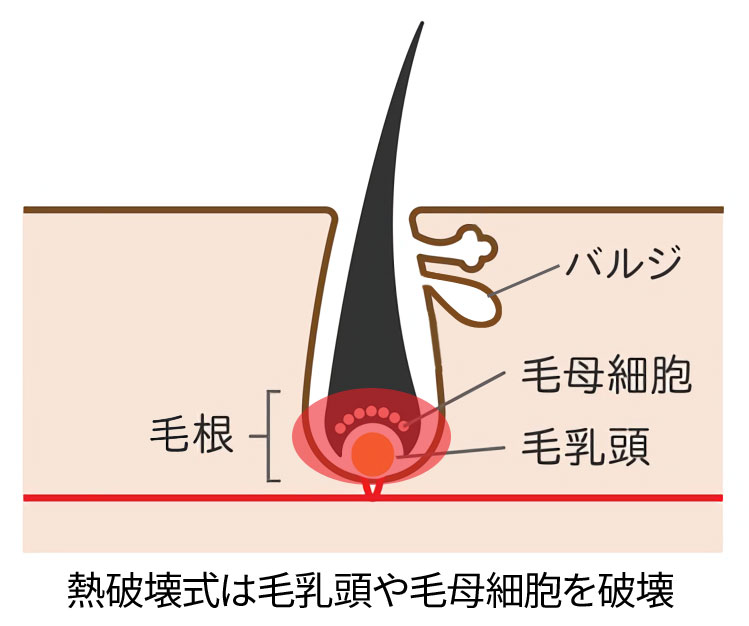 熱破壊式脱毛の仕組み