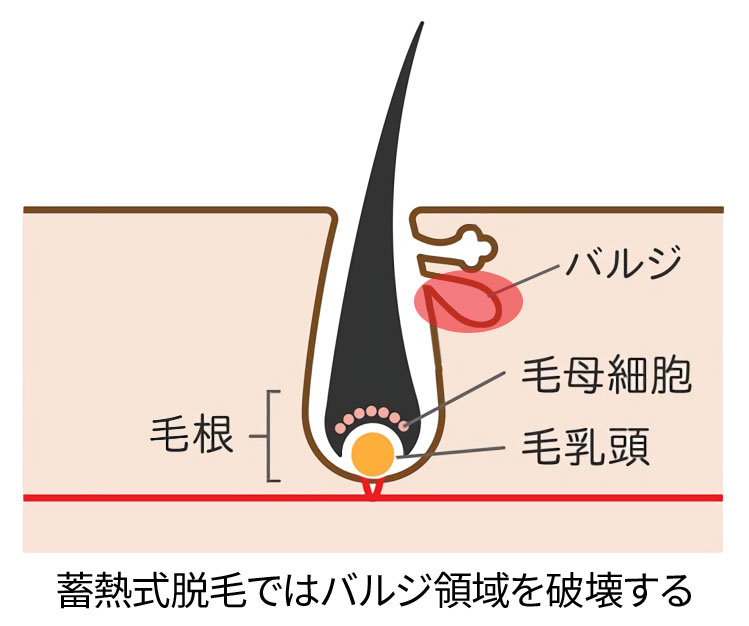 蓄熱式脱毛の仕組み