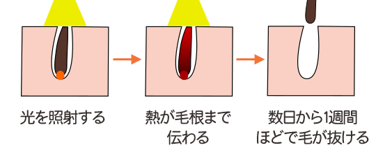 ライト脱毛の仕組み