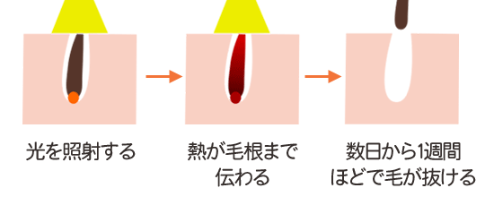 ライト脱毛の仕組み