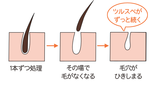 スーパー脱毛の仕組み
