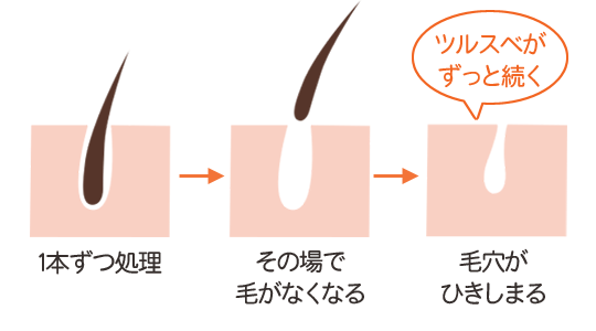 スーパー脱毛の仕組み